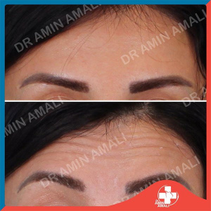 botox-injection-10