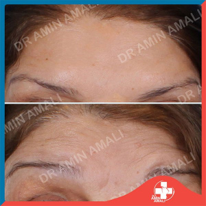 botox-injection-11