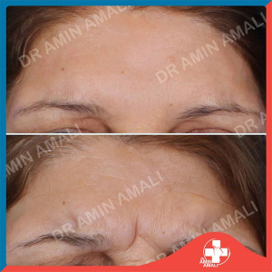 botox-injection-12