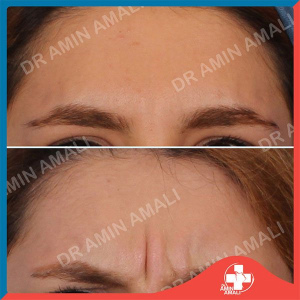 botox-injection-13