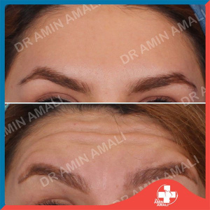 botox-injection-14