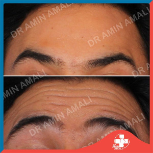 botox-injection-15