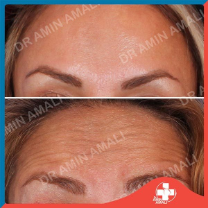 botox-injection-2