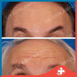 botox-injection-3