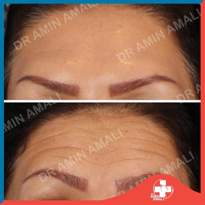 botox-injection-4