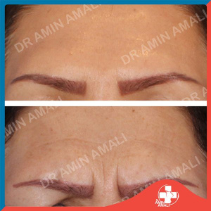 botox-injection-5