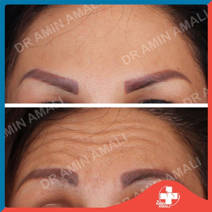botox-injection-6