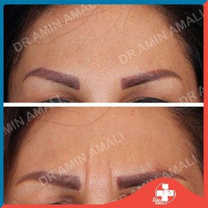 botox-injection-7