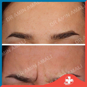 botox-injection-8