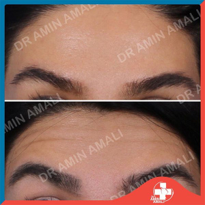 botox-injection-9