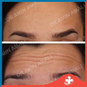 botox - dysport - xeomin - draminamali