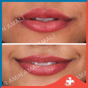 gel injection - gel - draminamali