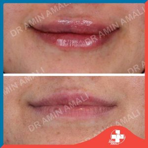 تزریق ژل - دکتر امین آمالی