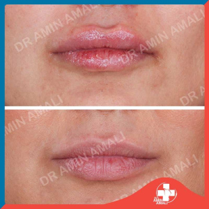 تزریق ژل - دکتر امین آمالی