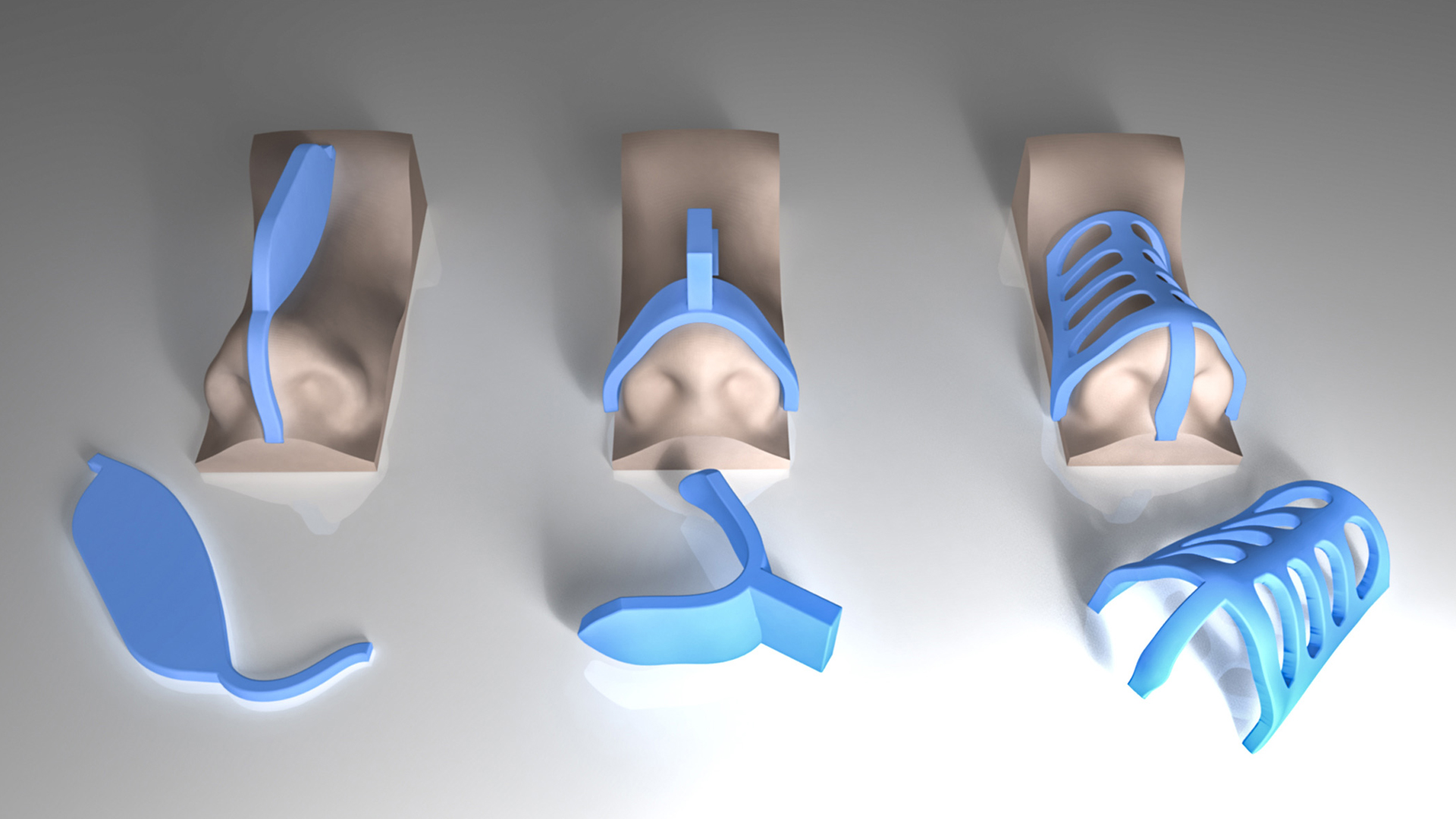 جراحی بینی با قالب های کنترلی