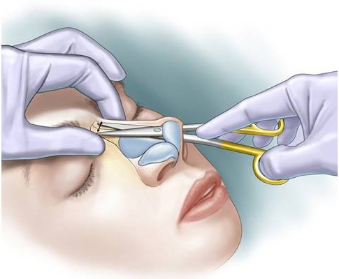 جراحی بینی به روش باز یا بسته؟