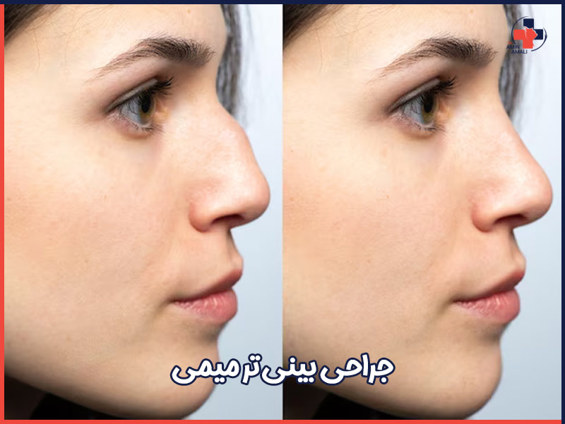 جراحی بینی ترمیمی در تهران - دکتر آمالی