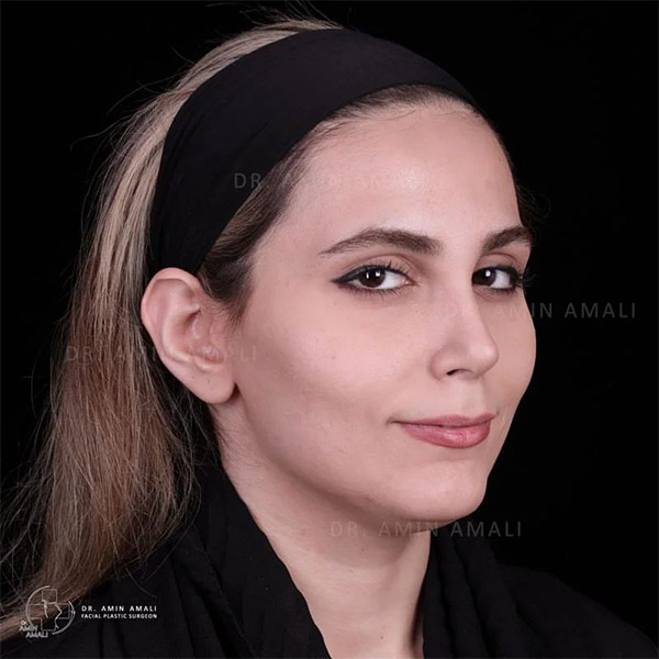 جراحی بینی استخوانی تهران - دکتر آمالی