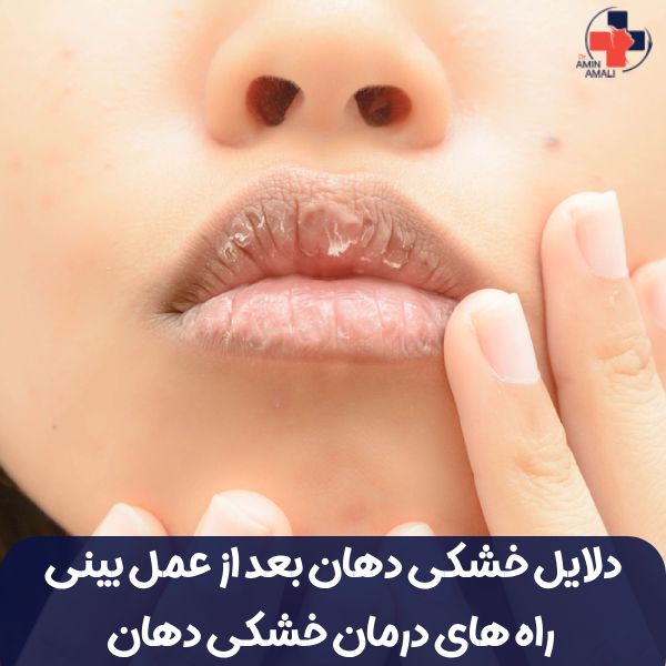 خشکی دهان بعد از عمل بینی