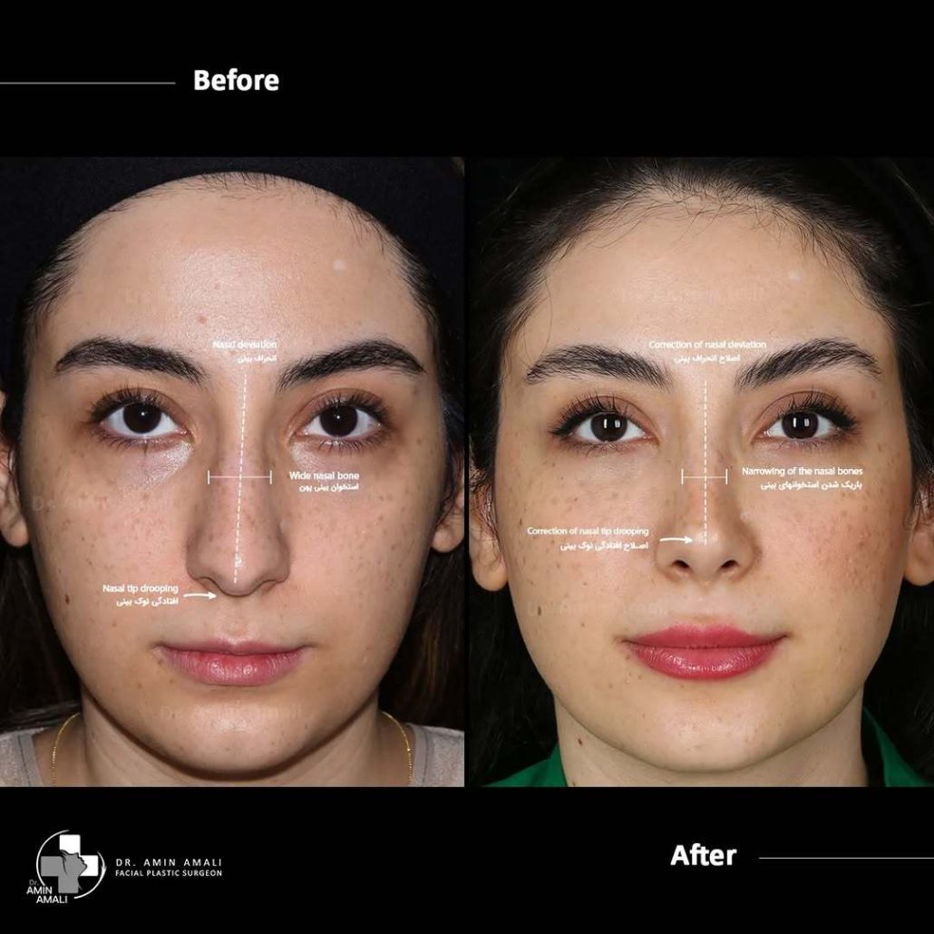 عکس عمل بینی قبل و بعد