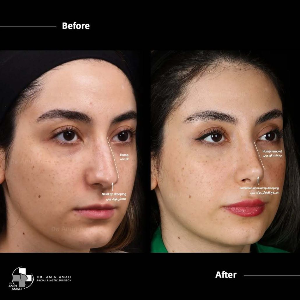 عکس عمل بینی قبل و بعد