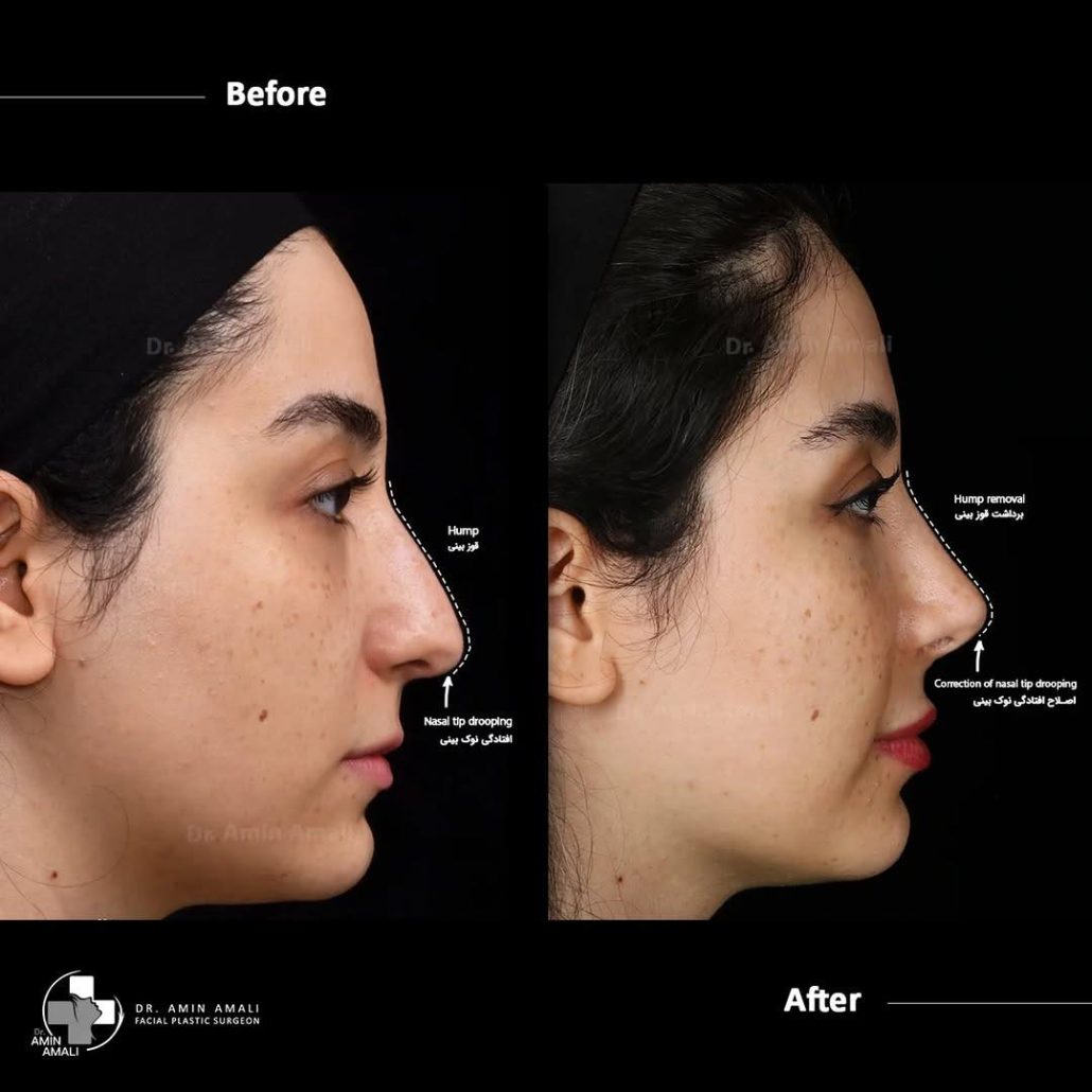 عکس عمل بینی قبل و بعد
