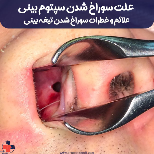 علائم و خطرات سوراخ شدن تیغه بینی + علت سوراخ شدن سپتوم بینی