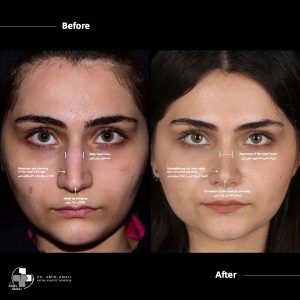 عکس قبل و بعد از عمل بینی استخوانی