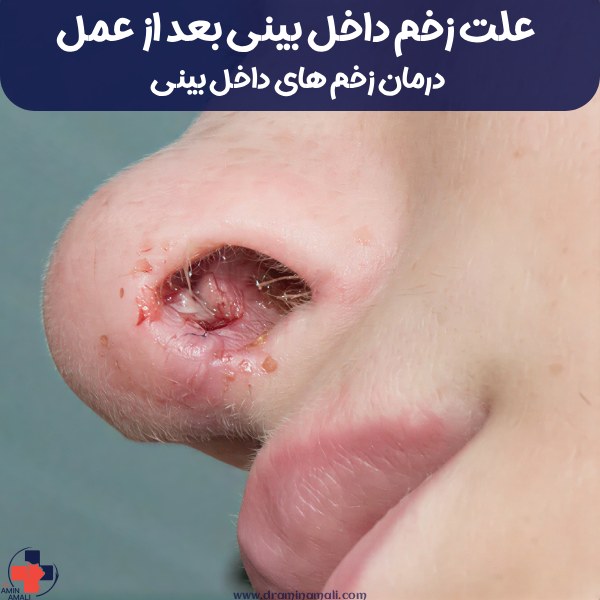 عکس زخم داخل بینی بعد از عمل