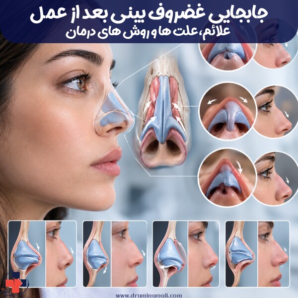 جابجایی غضروف بینی بعد از عمل؛علائم،علت ها و روش های درمان